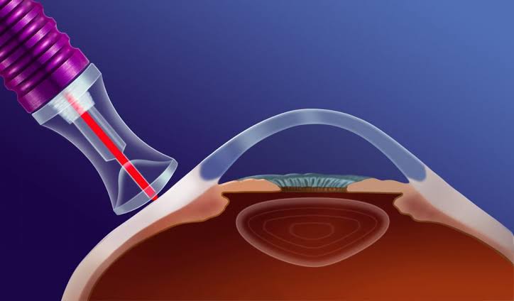 Ciclofotocoagulação com Laser MicroPulso