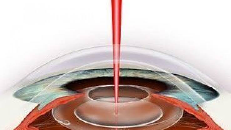 Capsulotomia Posterior com YAG LASER