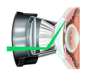 Trabeculoplastia Seletiva a Laser (SLT)