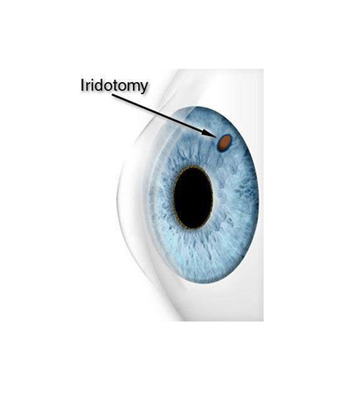 Iridectomia a laser com YAG LASER
