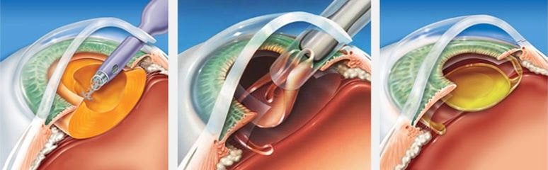 Cirurgia de Catarata (Facoemulsificaçao) com Microincisão